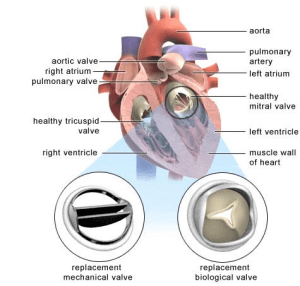 aortic valve replacement