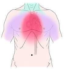 angina pectoris