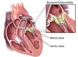 Endocarditis