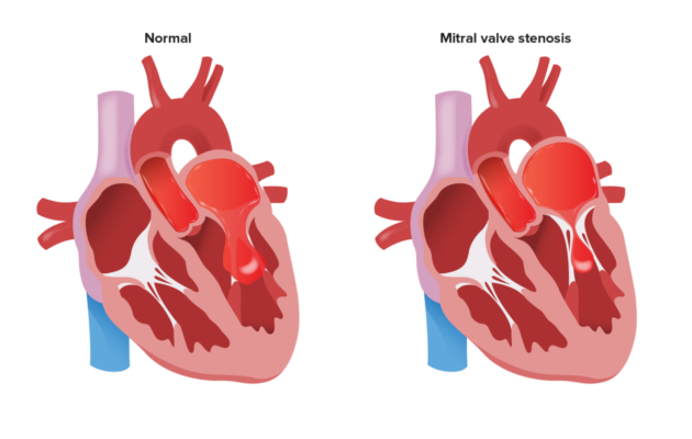 Mitral valve stenosis