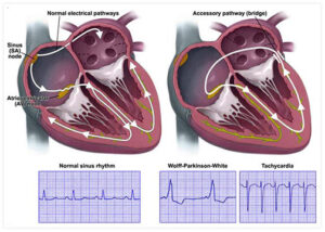 Tachycardia