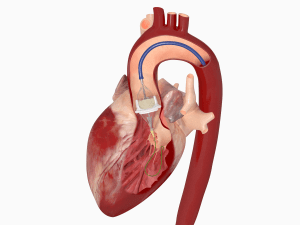 TAVR