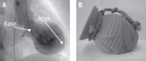 Takotsubo cardiomyopathy