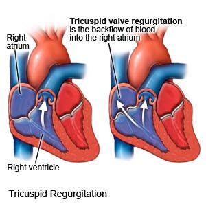 Tricuspid valve regurgitation