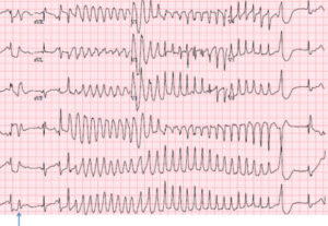 VT ( ventricular tachycardia)