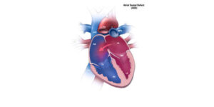 atrial septal defect