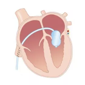 Mitral valve balloon valvuloplasty