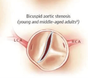 bicuspid aortic valve