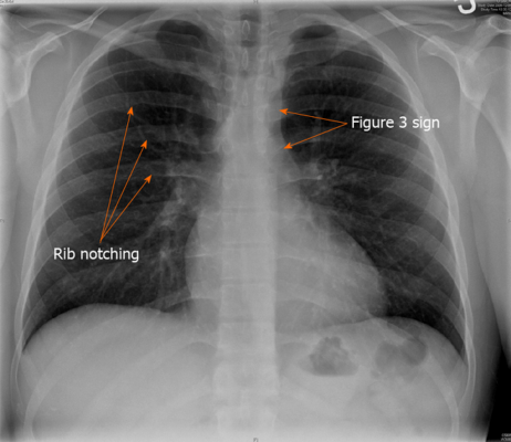 coarctation of the aorta chest x ray