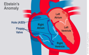 Ebstein anomaly