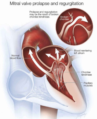 mitral valve regurgitation