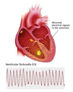 ventricular tachycardia