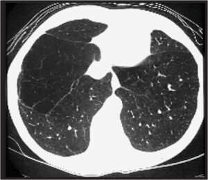 ct scan copd