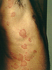 Urticaria cronica