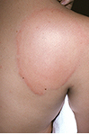 Urticaria cronica