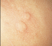 Urticaria cronica